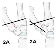 Figure 2: Figure 2A: Transfixation of K-wire to the 2nd metacarpal after applying longitudinal traction and achieving reduction of fracture at the base of the 1st metacarpal. Figure 2B: Stabilising the fixation by transfixing the base of the 1st metacarpal to the trapezium.