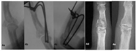 Figure 4: Figure 4A: Complex intra-articular pattern treated with dynamic double parabolic k-wires; Figure 4B: Lateral view showing reduction after ligamentotaxis; Figure 4C: Joint space and fracture alignment is maintained even on flexion of PIP joint; Figure 4D: 5 weeks after removal of the hardware. Figure 4E: 6 months postoperative film shows healing.