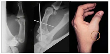 Figure 5: Figure 5A: Bennett's fracture dislocation; Figure 5B: Treated with ligamentotaxis with k-wires; Figure 5C: Functional outcome of the thumb with healed pin tracts.