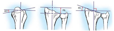 Figure 3: Normal average distal radial angles. Radial inclination (RI; average 22 degrees). Radial length (RL; average 12 mm). Radial tilt (RT; average 11 degrees volar).