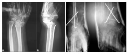 Figure 6: Pre Operative X-Ray; Figure 7: Post Operative X-Ray